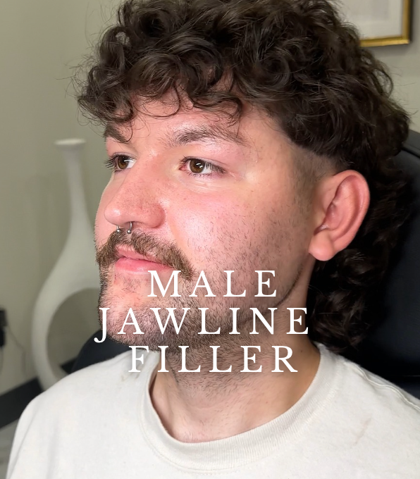 INJECTABLES: Male Jawline Filler