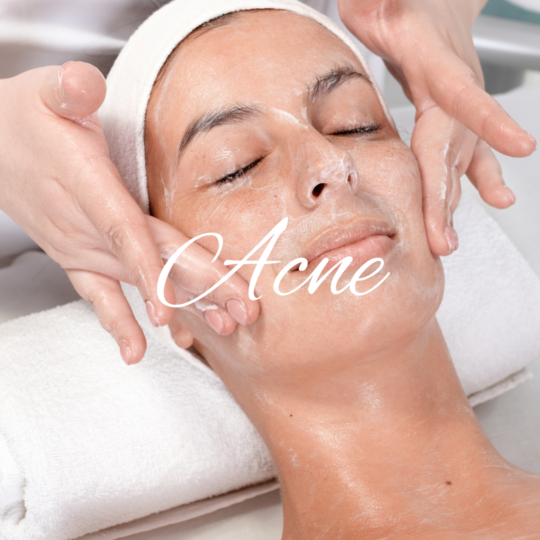 FACIAL: ACNE